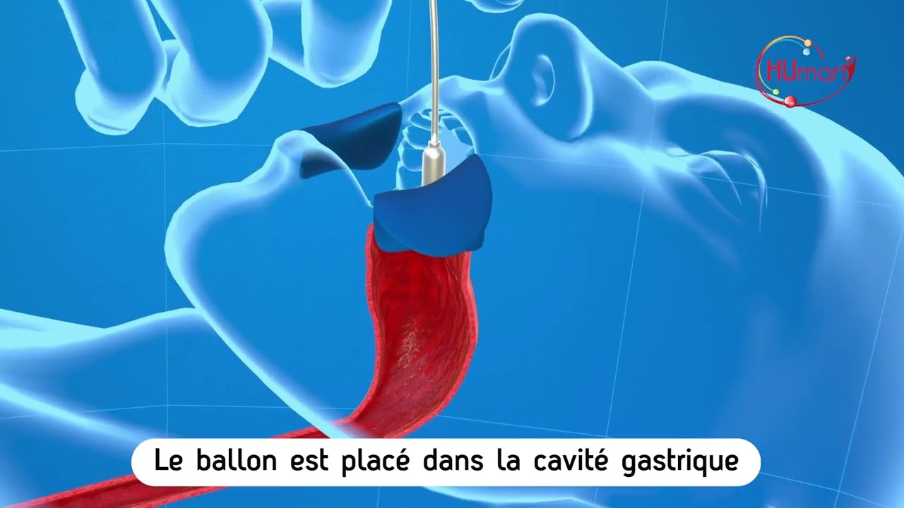 Le ballon intragastrique
