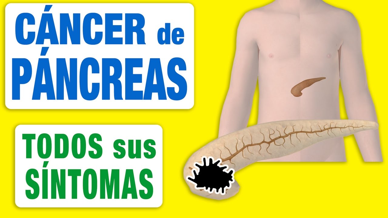 Todos los Síntomas del Cáncer de Páncreas