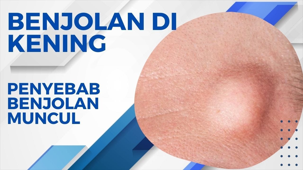 Penyebab Muncul Benjolan di Kening, Bahayakah?