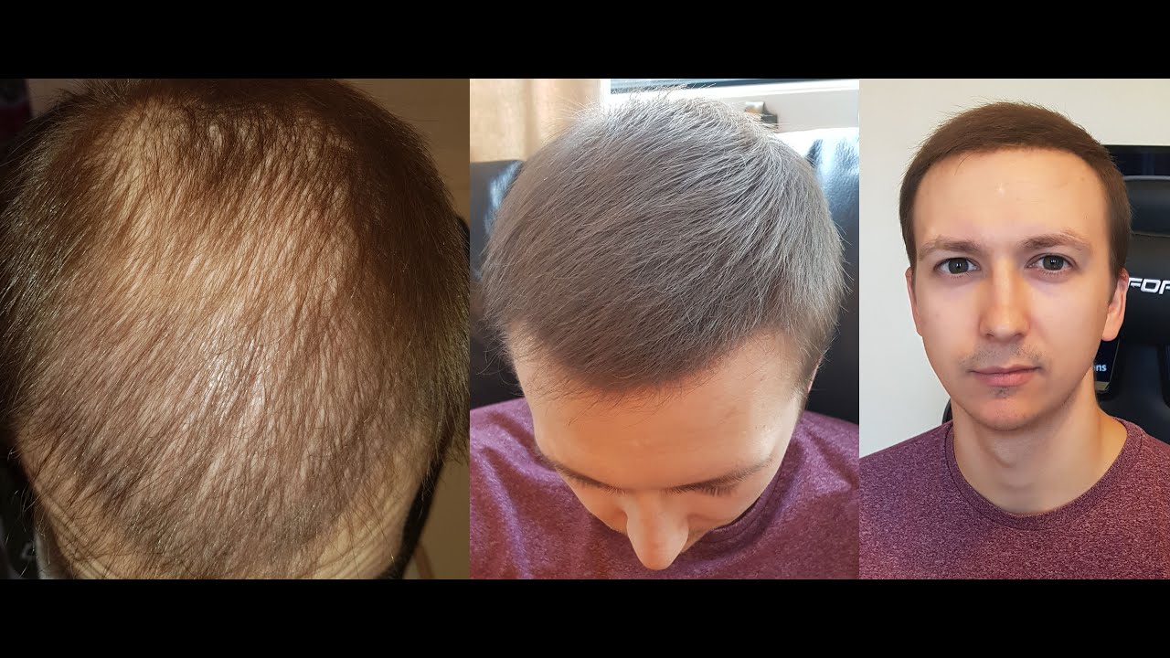 Hair Loss Concealers. Dermmatch & Toppik Hair Fibers Experiment 2020