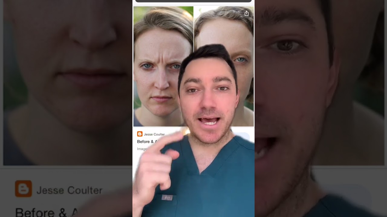 Frown Lines aka Eleven Lines aka The 11's how to treat them - TikTok SkinDoc