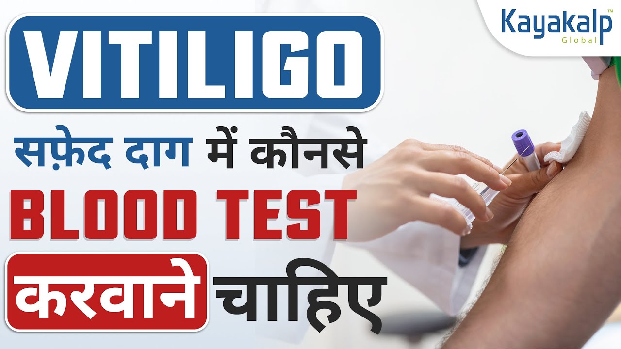 Vitiligo पीड़ितों के लिए सबसे महत्वपूर्ण Test | Blood Test For Vitiligo | Kayakalp Global