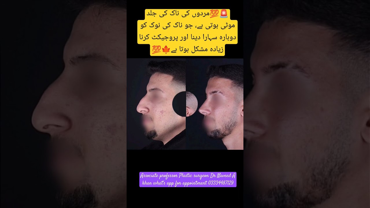 #MaleRhinoplasty#NoseSurgery#FacialSurgery#CosmeticSurgery#PlasticSurgery#MenBeauty#NoseJob
