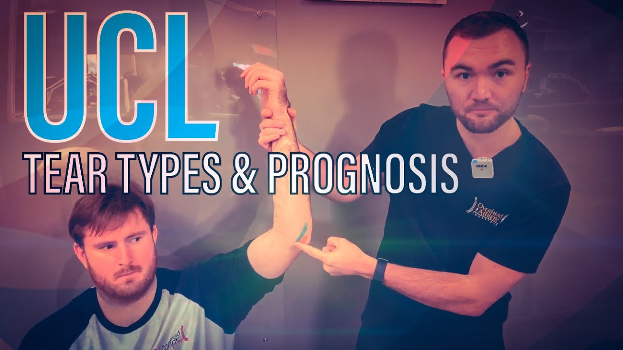 Разрыв UCL: типы и прогноз