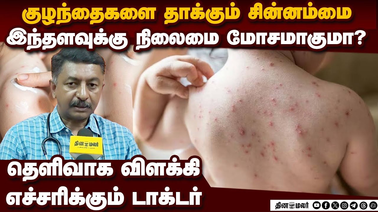 சின்னம்மை பரவல் அதிகரிப்பு பாதிப்பு எந்தளவுக்கு மோசமாகும்? Chickenpox outbreak India