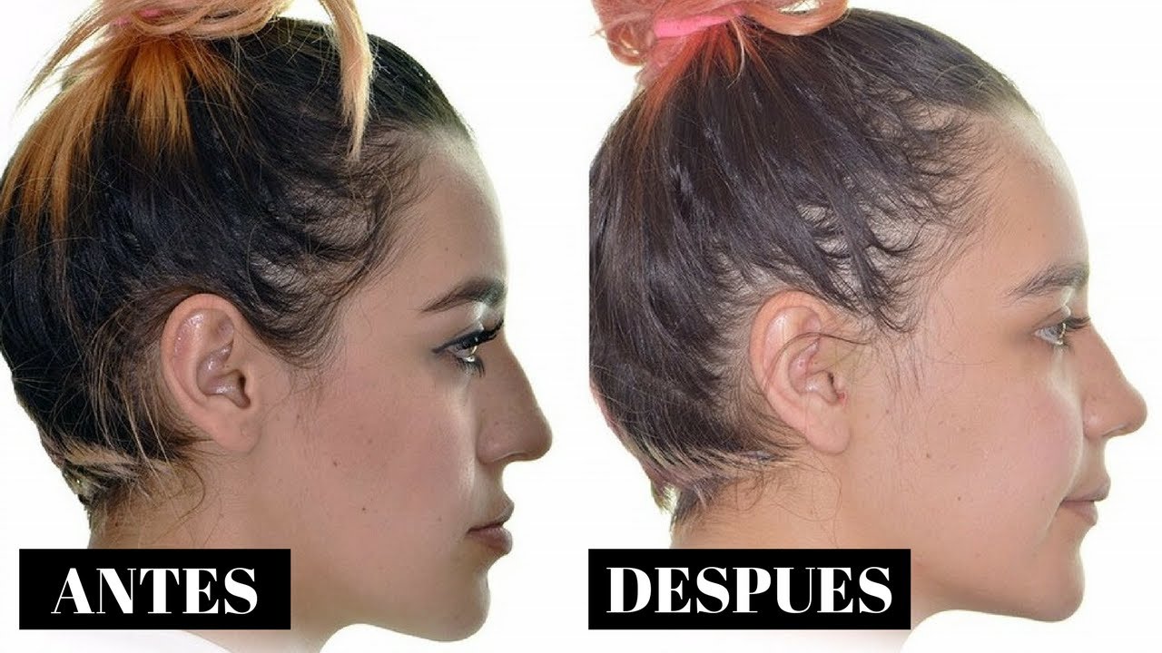 CIRUGÍA MAXILOFACIAL l MI EXPERIENCIA l ¿QUE PASO CON MI NARIZ? l Sofia Castro