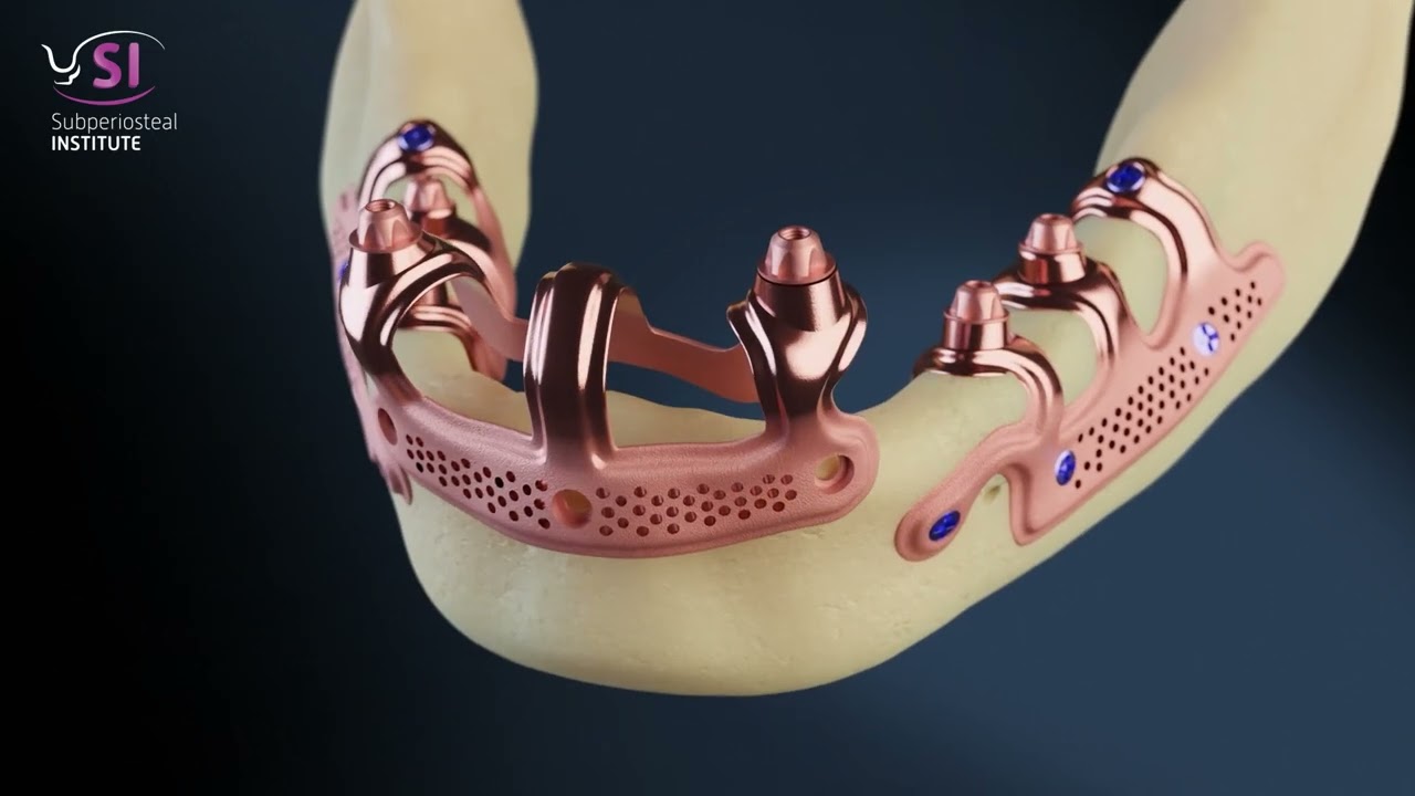 The concept of subperiosteal implants in the maxilla and mandible