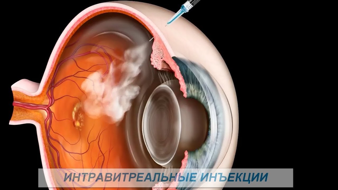 Интравитреальные инъекции &ndash; (Anti VEGF, Eyelia, Lucentis). Зачем, почему, как?