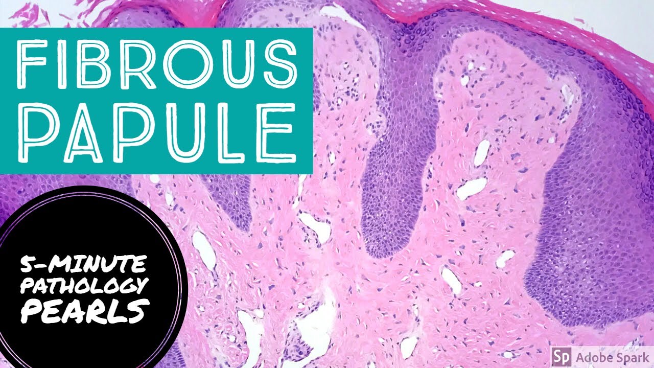 Fibrous Papule (Angiofibroma): 5-Minute Pathology Pearls