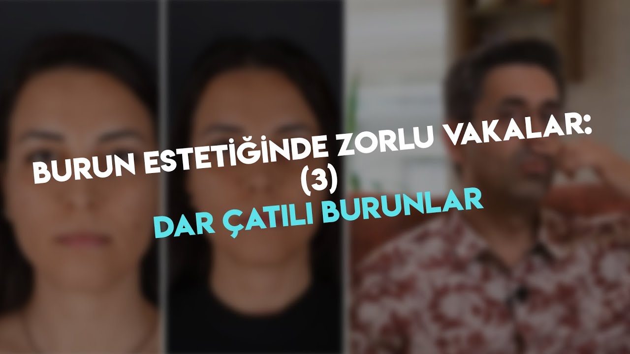Burun Estetiğinde Zorlu Vakalar: (3) Dar Çatılı Burunlar