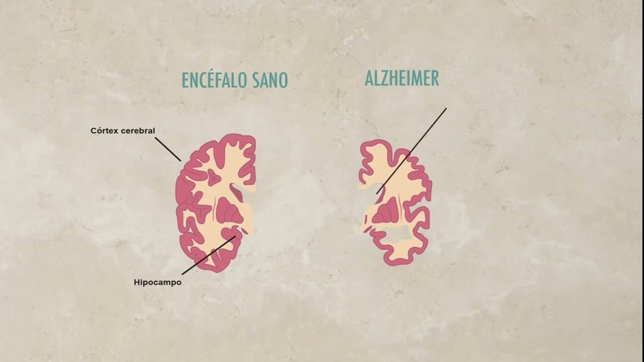 El cerebro con Alzheimer