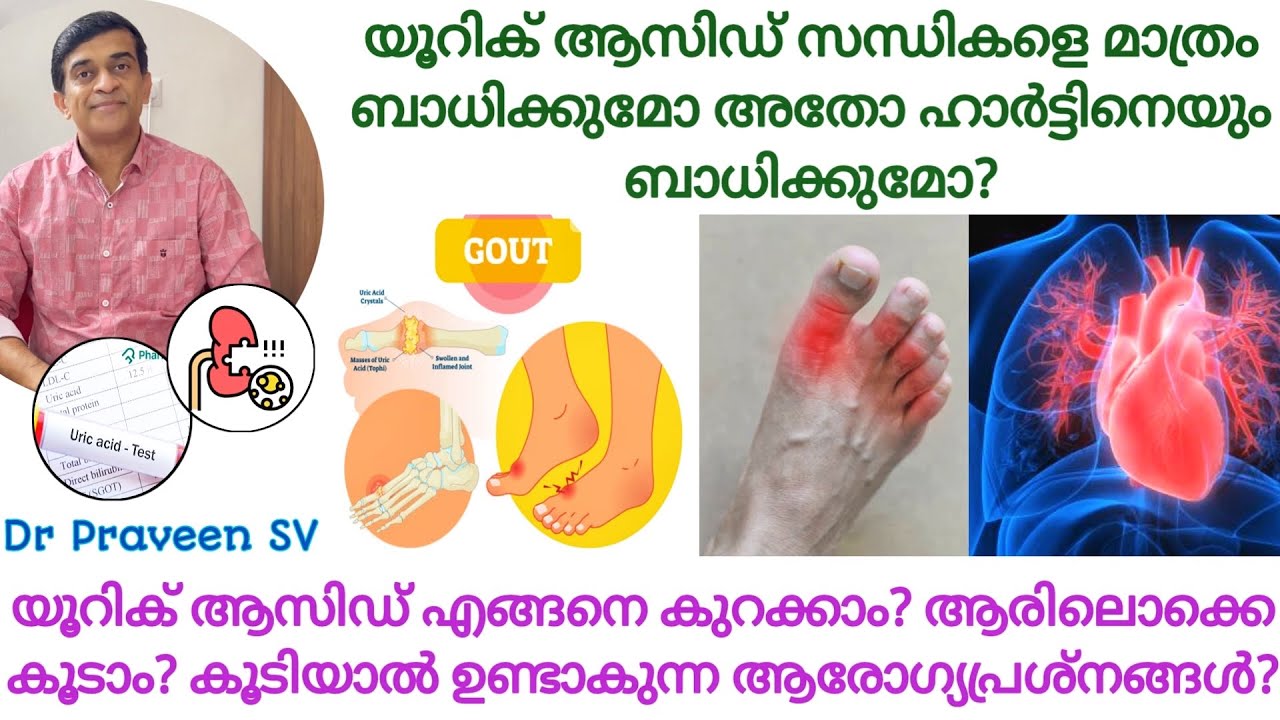 Uric acid malayalam|Uric acid treatment malayalam lUric acid koodiyal malayalam|Uric acid kurakkan