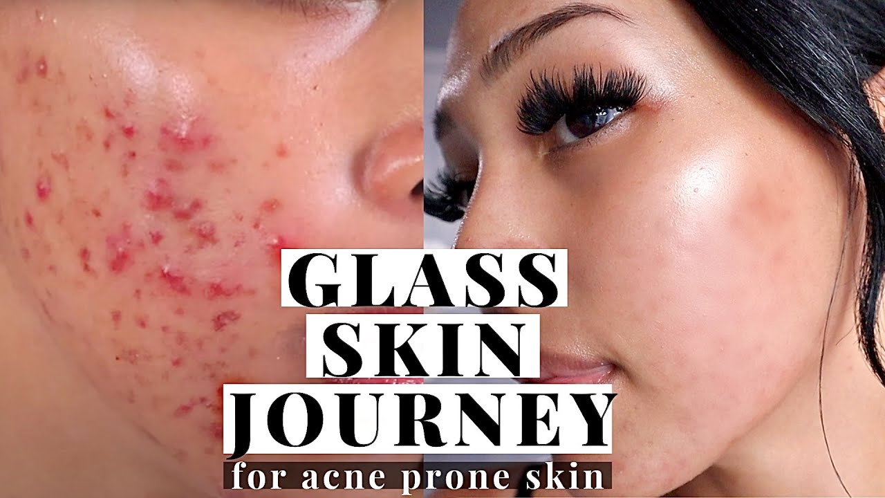 *AFFORDABLE* Glass Skin Journey for Acne Prone Skin | Korean Skincare Ft. Numbuzin