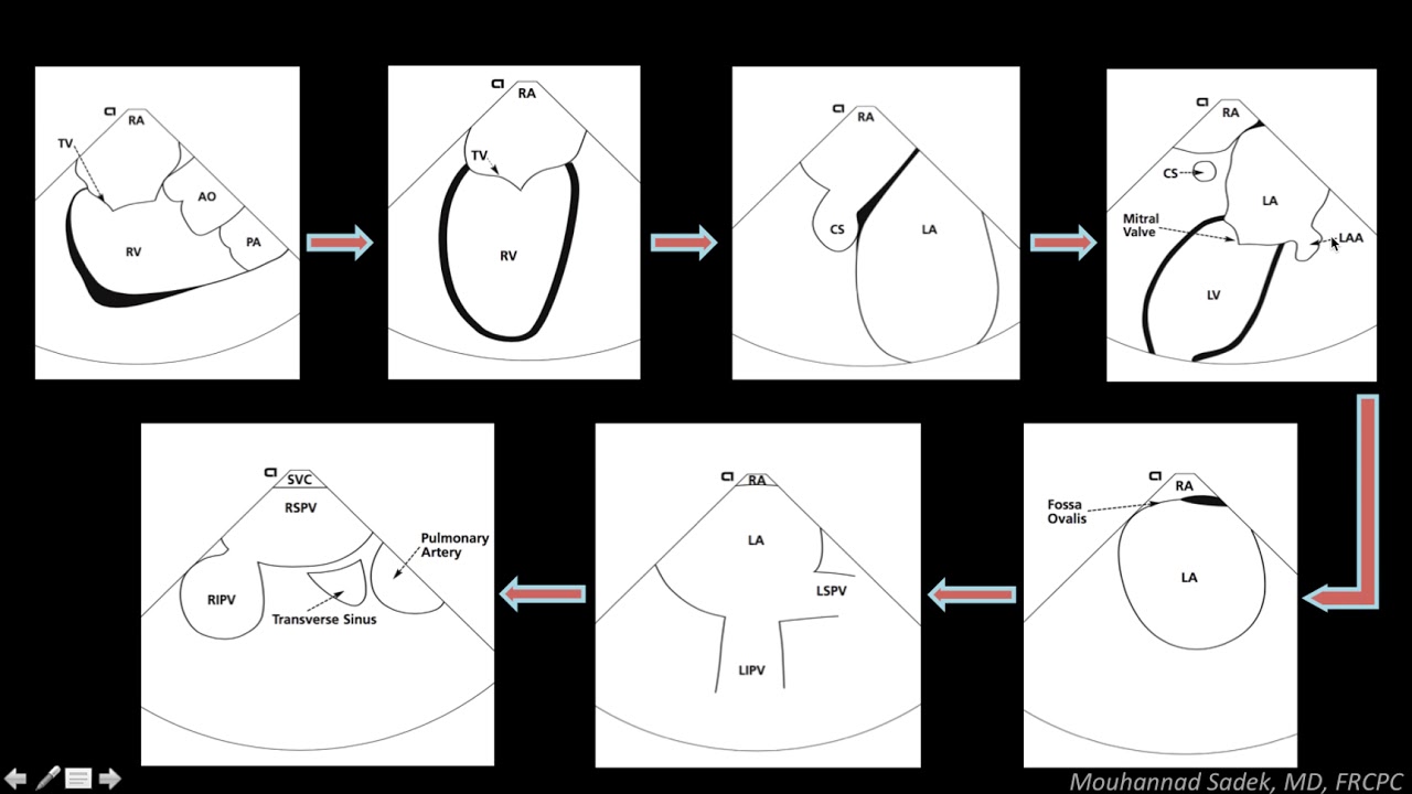 Intracardiac Echocardiography in EP Procedures - How can it help?