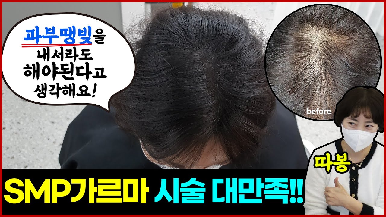 50대 탈모 가르마,정수리 두피문신! 이건 과부땡빚을 내서라도 해야되요!!