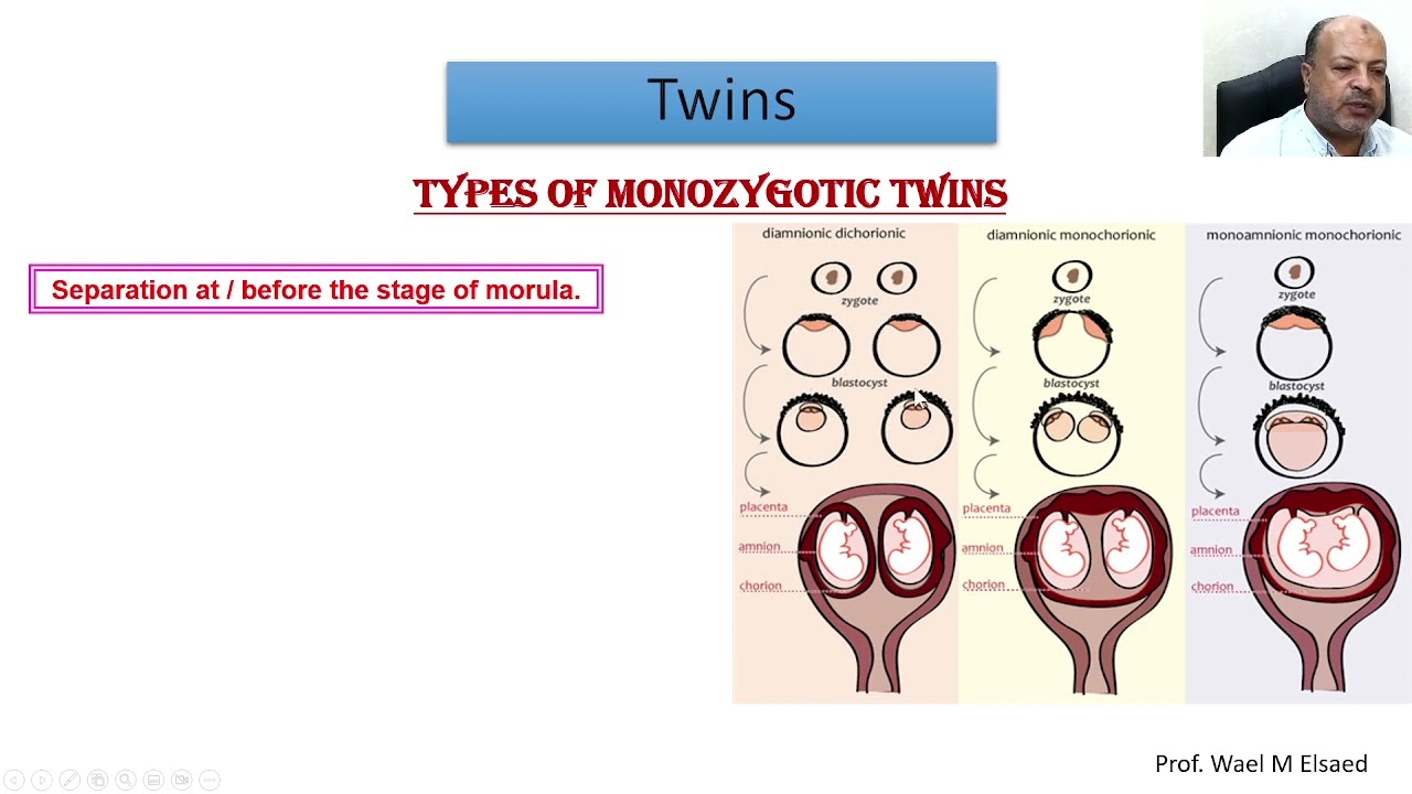 Embryology of Twins and birth defects