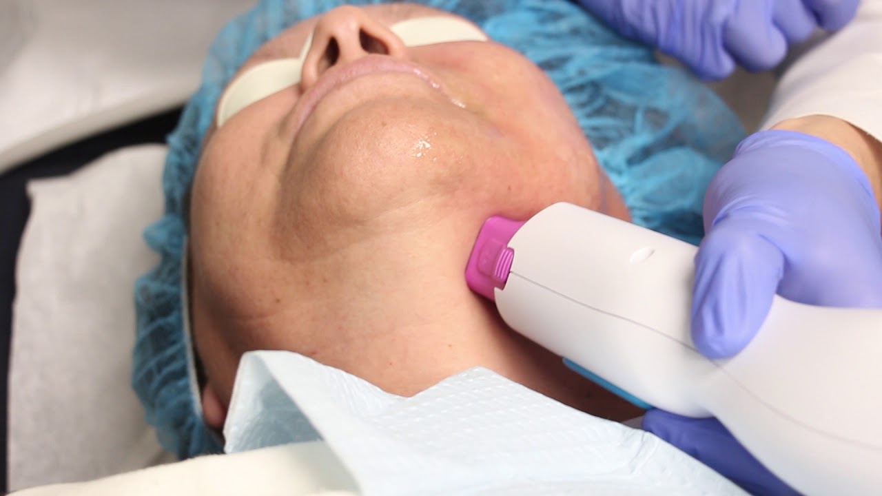 New Thermage FLX for Smooth Skin on the Face