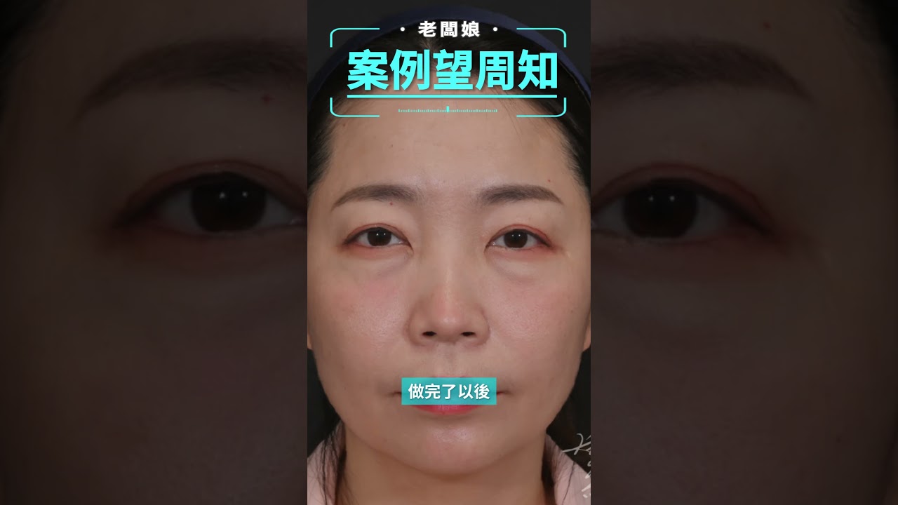 「案例望周知」 眼袋手術分析