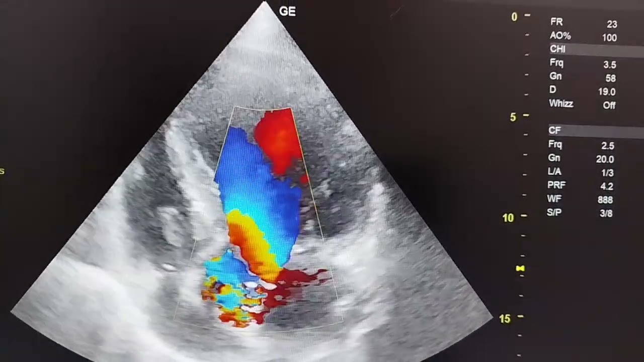 Dilated Left Ventricle, Concentric Left Ventricular Hypertrophy, Moderate Eccentric Aortic Regurge 