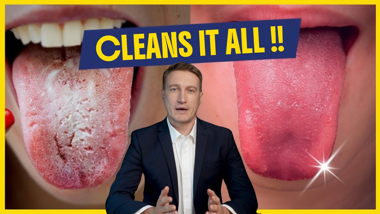How to GET RID of WHITE TONGUE & Tongue Coating? | The TRUTH REVEALED.