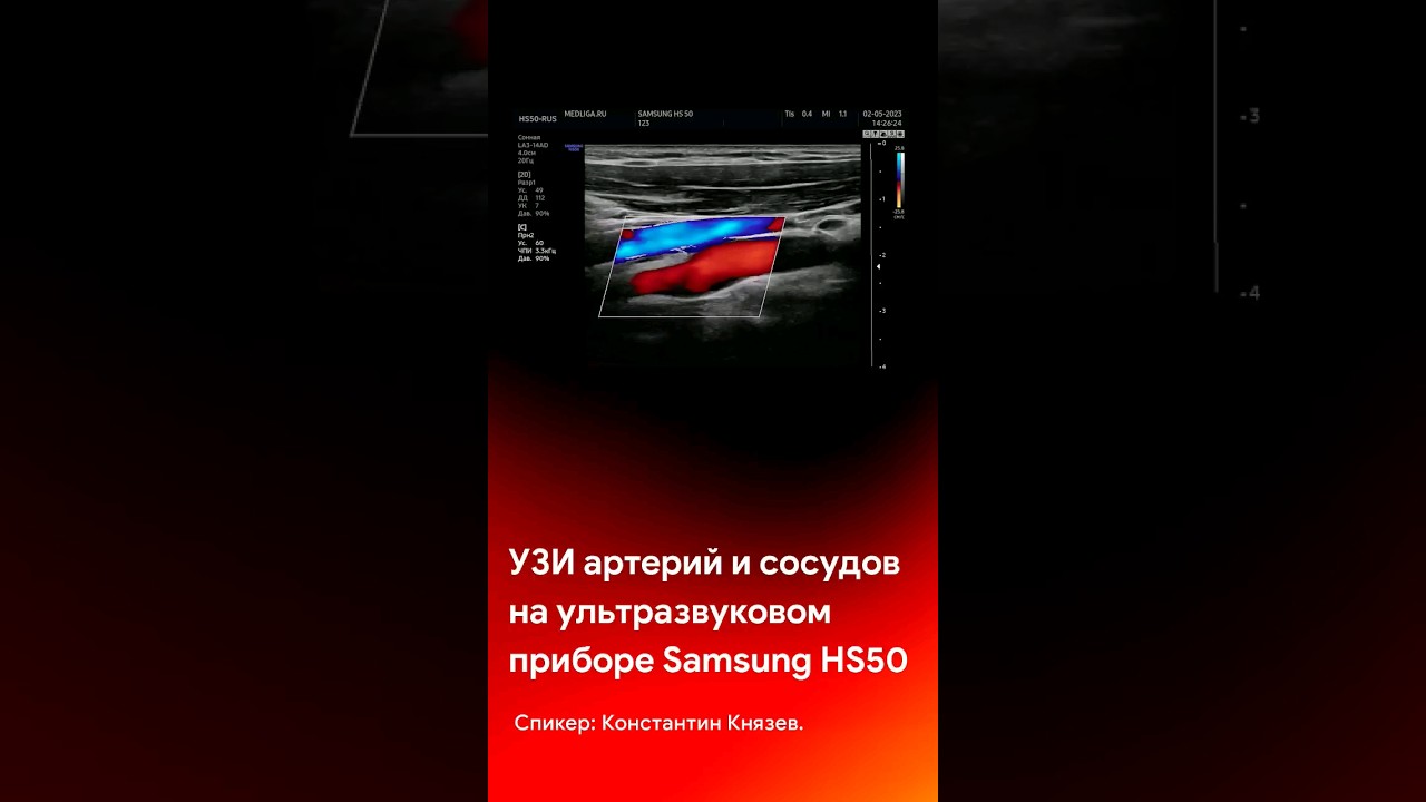 УЗИ артерий и сосудов на Samsung HS50. Смотрите на канале @medliga #short #shortvideo #shorts