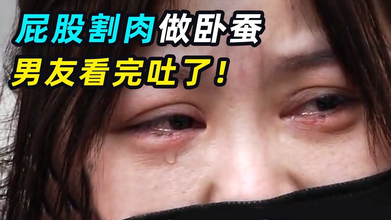 一口气看完6个奇葩整容，美女用臀部组织做卧蚕翻车，男友：分手吧！