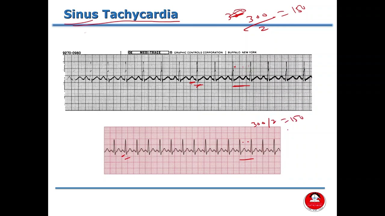 ECG Fingerprints: Identifying Dysrhythmias