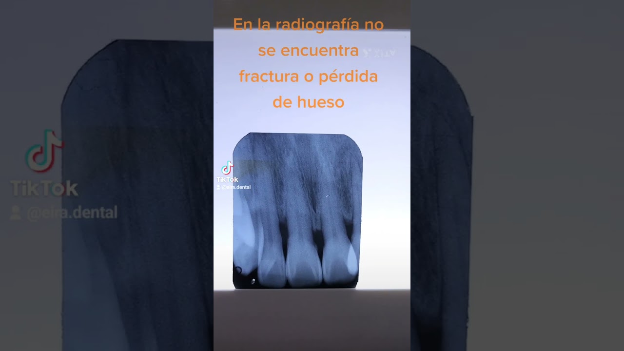 Fractura de ra&iacute;z dental #dentist #dental #dentista #implantesdentarios #cirugiamaxilofacial