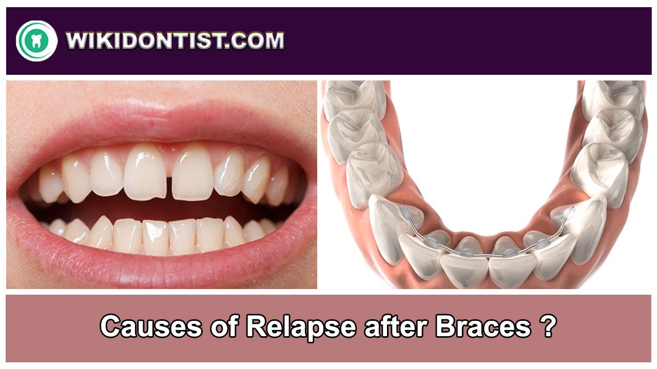 Causes of Relapse after Braces ?