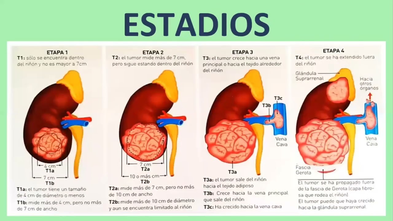Cáncer Renal