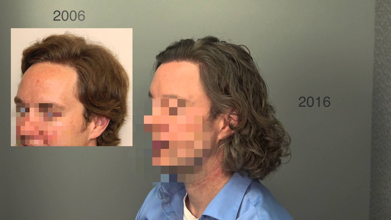 Dr. Cooley Hair Transplant Result in 4K Ultra HD