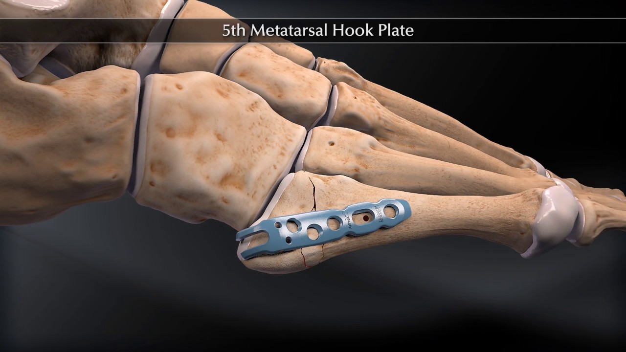 5th Metatarsal Hook Plate
