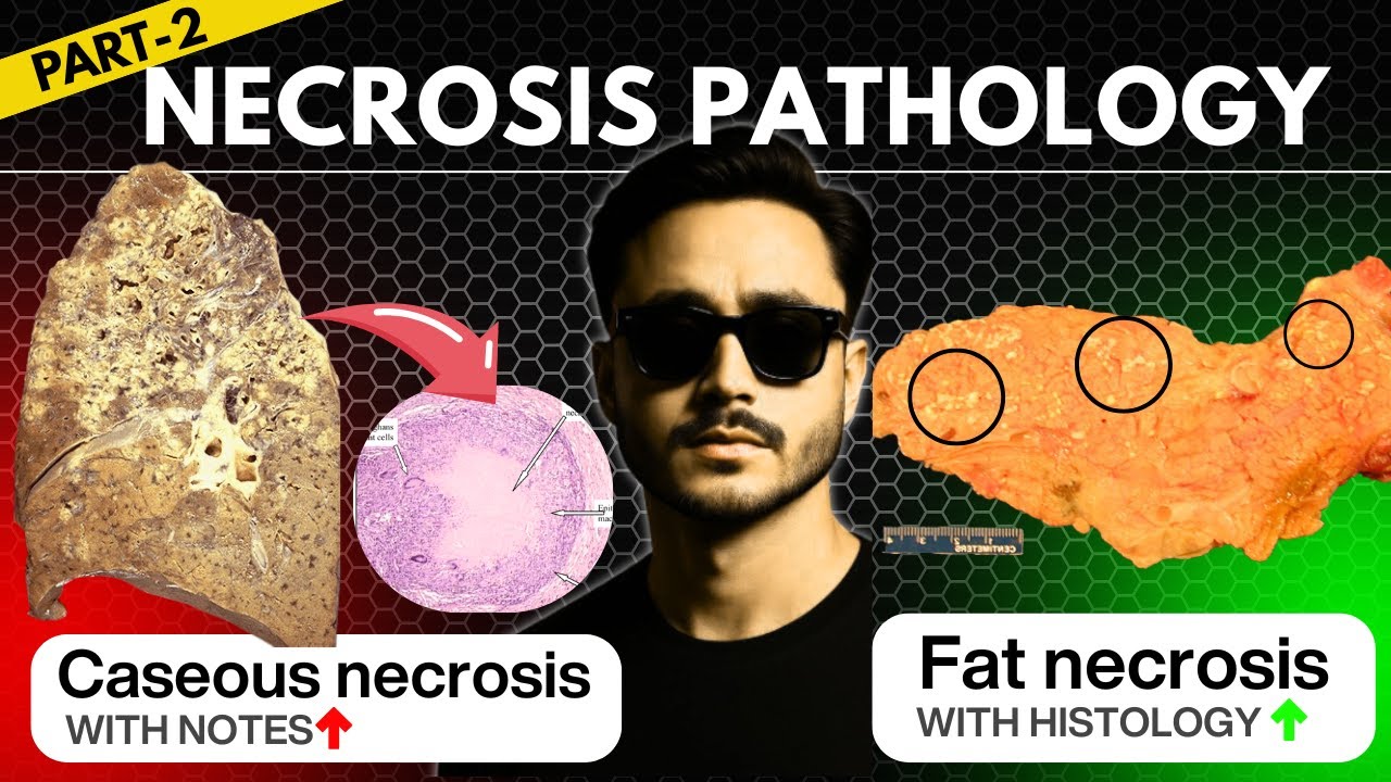 caseous necrosis pathology | fat necrosis general pathology fibrinoid necrosis cell injury pathology