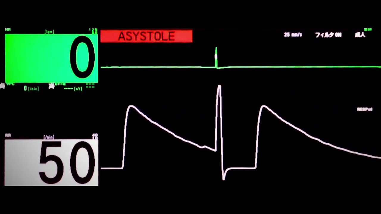 心電図モニター 実際の測定　VFIB→Tachycardia→電極確認→Asystole[NIHONKOHDEN WEP-5200]