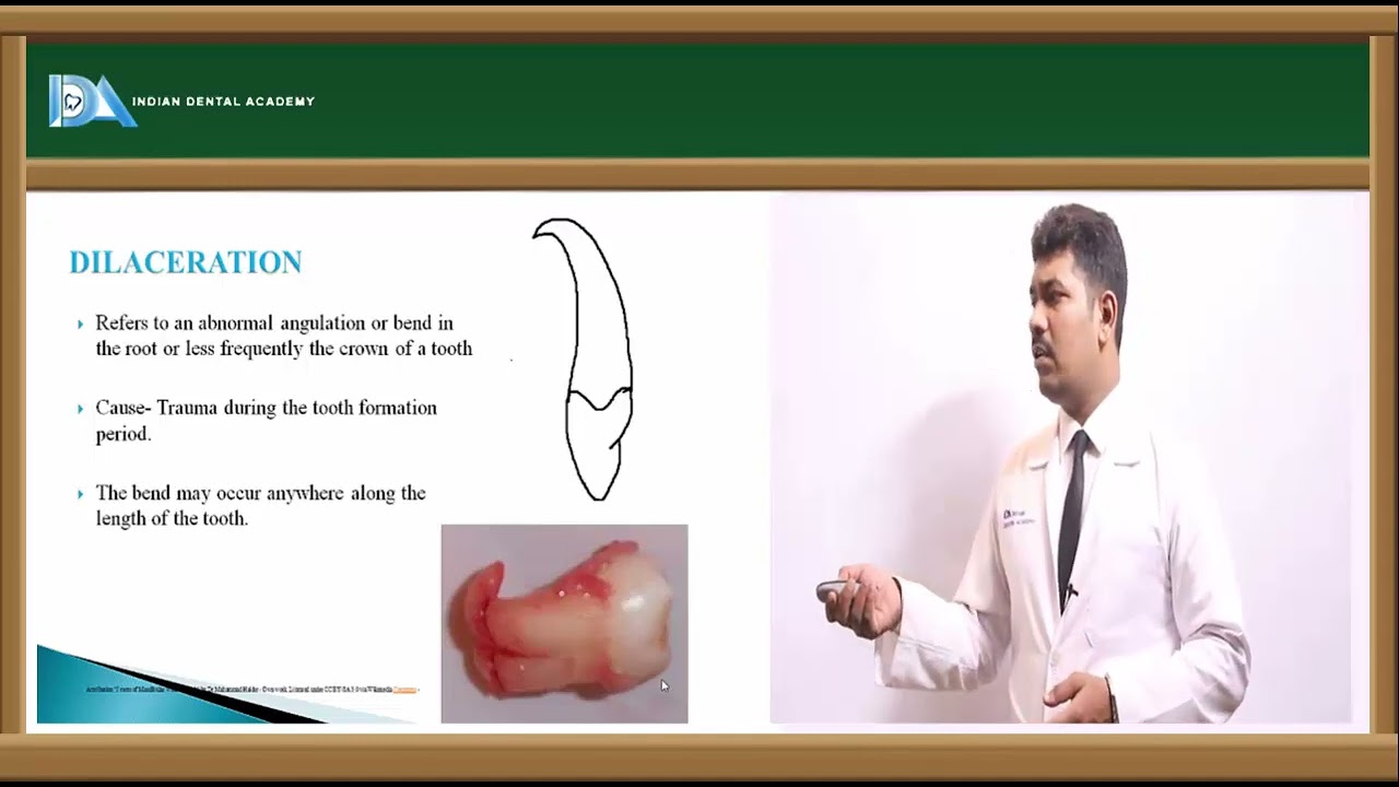 Developmental disturbance of teeth