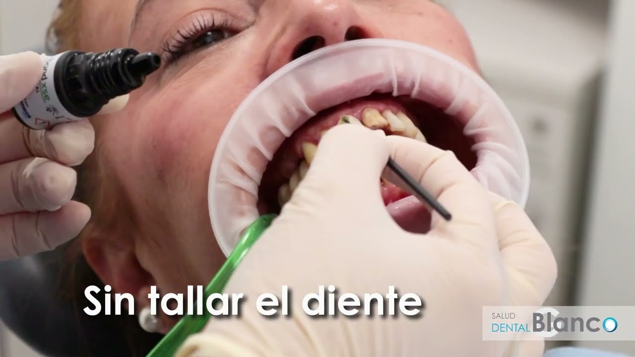Carillas dentales Salud Dental Blanco