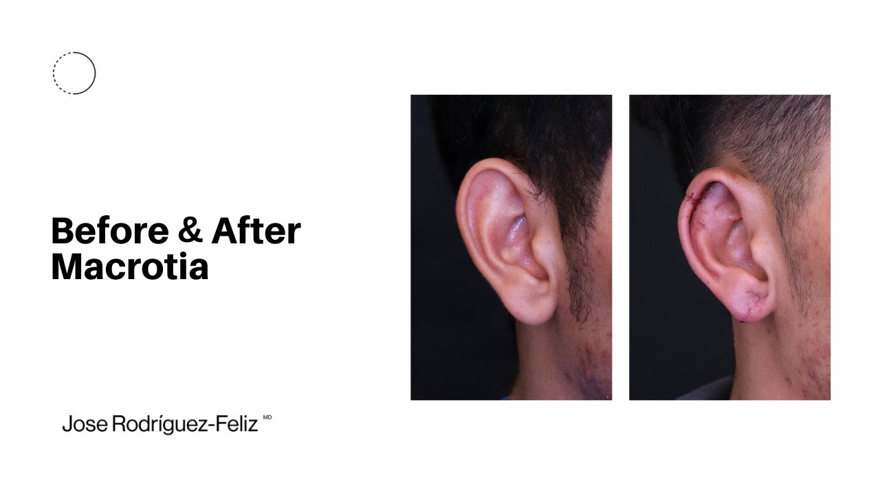Before & After. Macrotia
