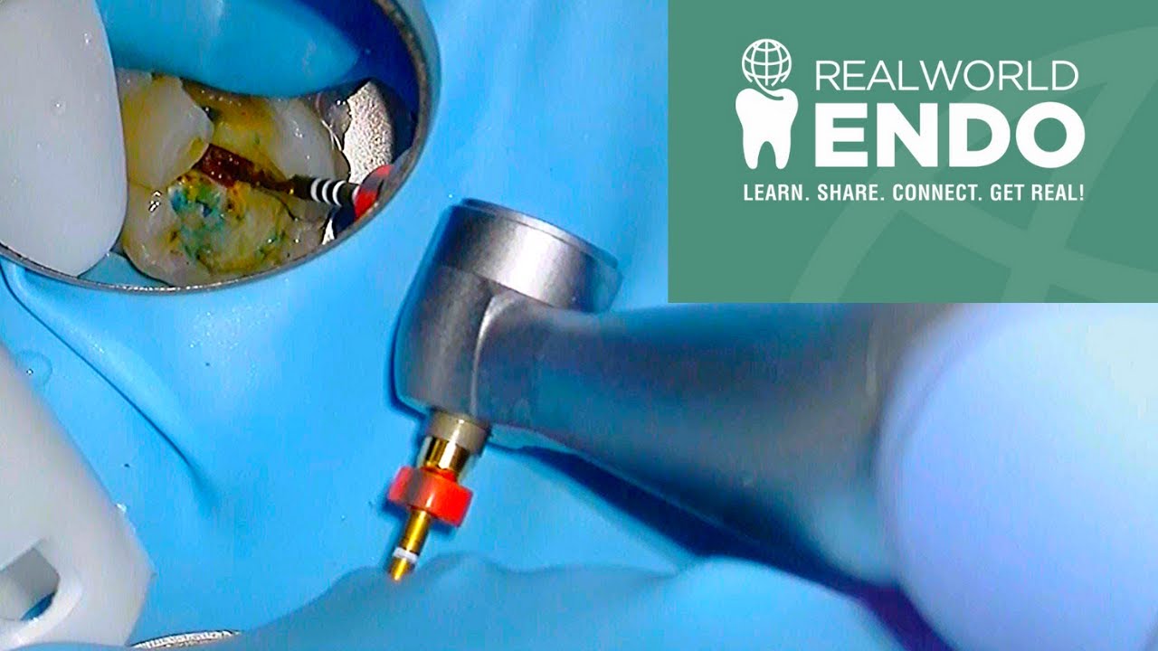 Root Canal Tips with Dr. Allen Ali Naseh, a RealWorld Endodontist!😄@EndosKool