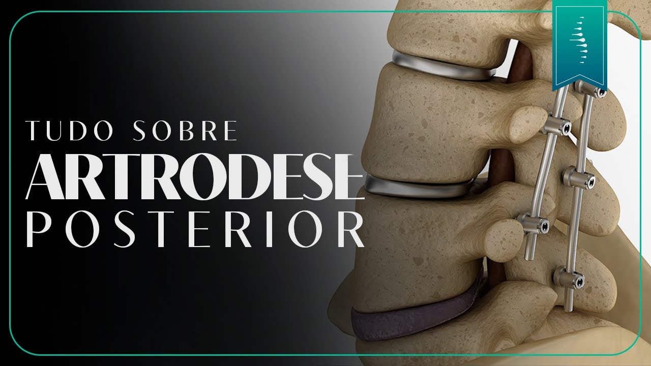 Artrodese posterior: Fixação da coluna com parafusos: como funciona?