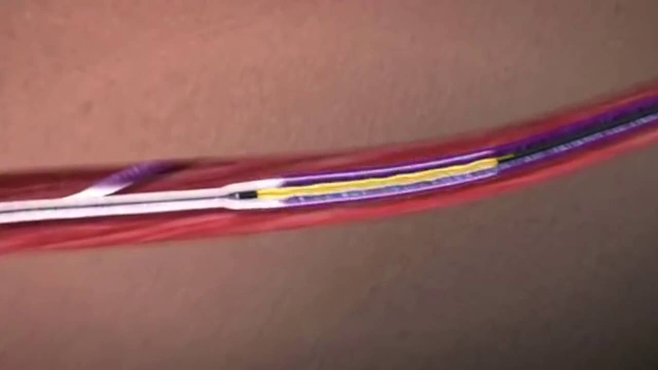 technique laser endo veineux