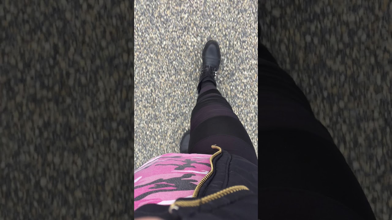 Fitbone Removed Safely 2.5 Years Post-Surgery