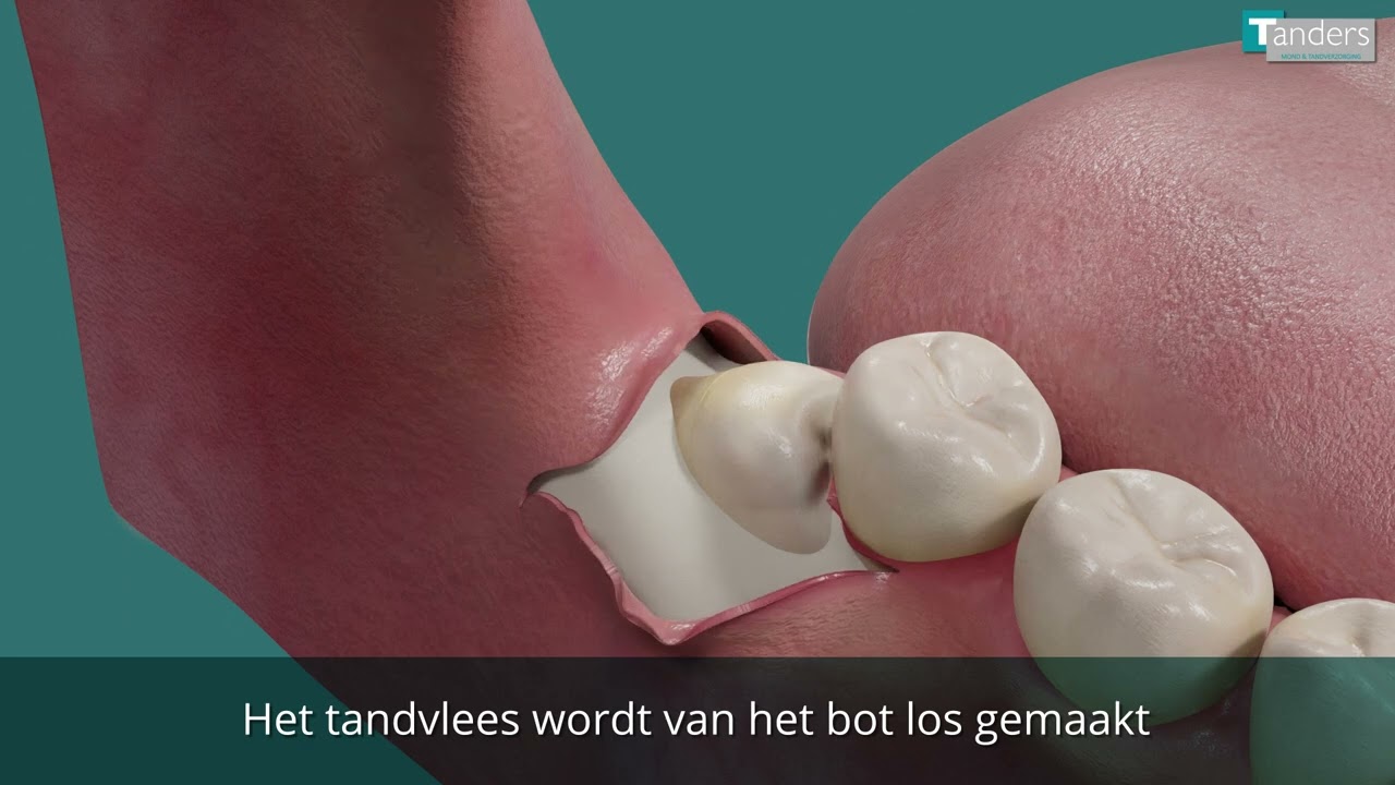 Verwijderen van een verstandskies