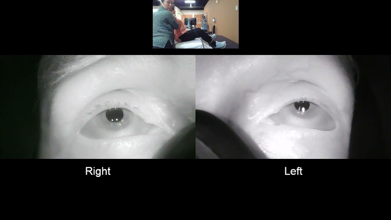 Bow+Lean Test Ageotropic LEFT HC BPPV