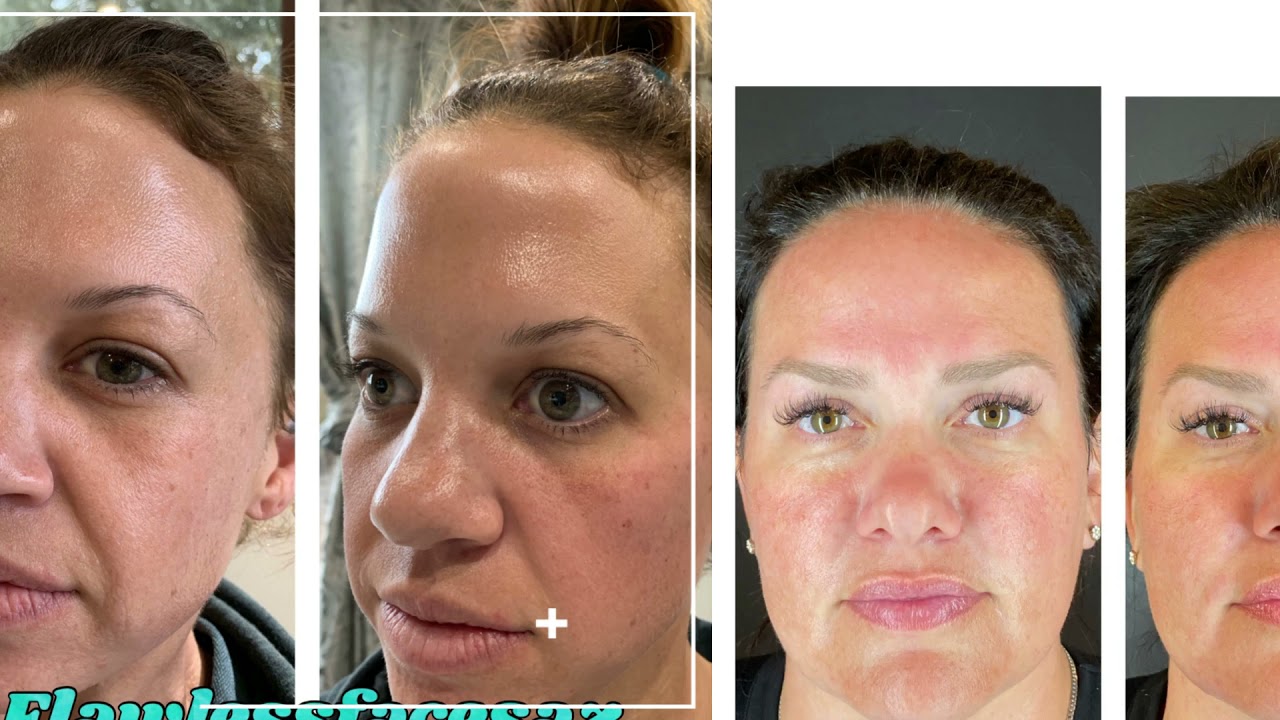 Botox near me