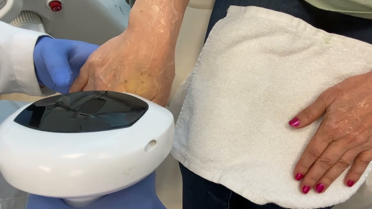 IPL for Hands rejuvenation and treatment of Dark Spots in OC Beauty Medspa