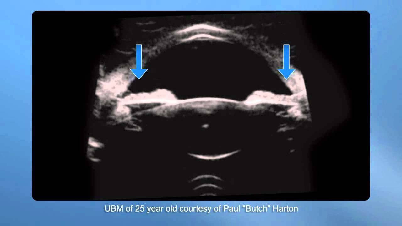 Goldberg UBM file in motion during accommodation - Supplementary video: 25983