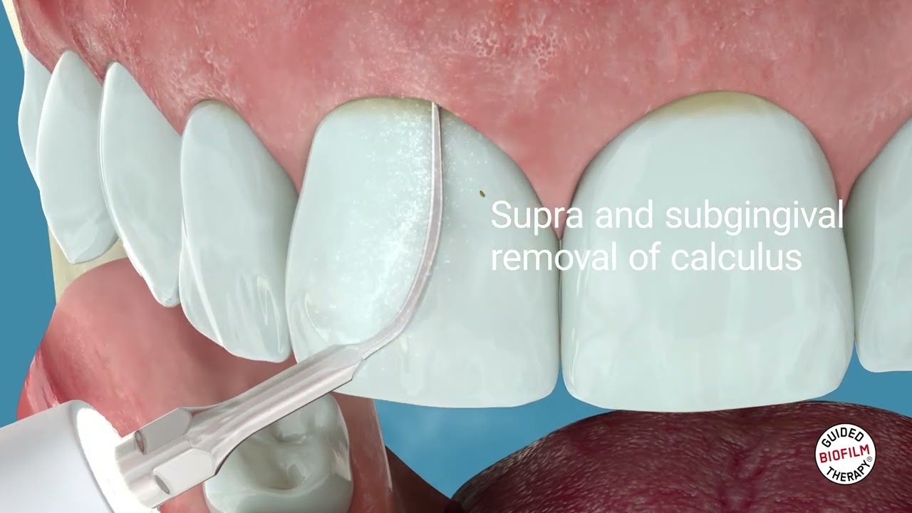 PIEZON® PS: The ultimate tool for Pain-Free Biofilm removal