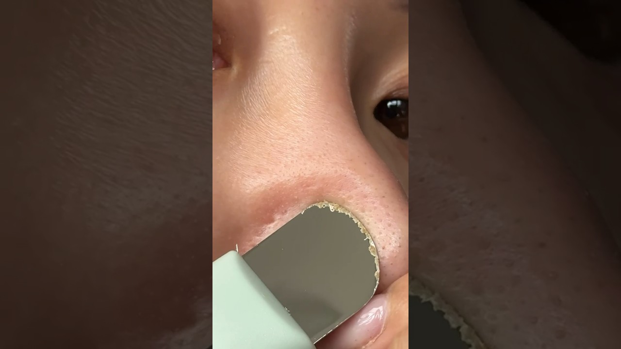 BEST BLACKHEAD REMOVER TOOL?