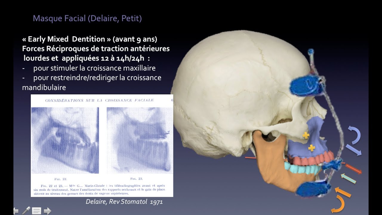 Biomécanique Orthodontique N°3 : Masque Facial de Delaire