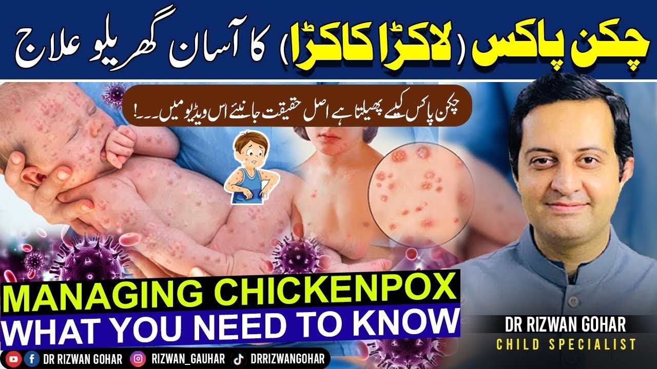 Chickenpox: How to avoid it, how to treat it, and what to do if you get it #chicken pox #treatment
